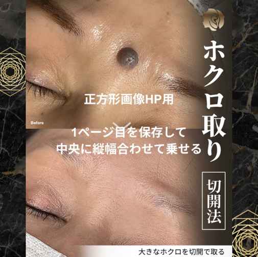 ホクロ取り(切開法)の症例写真
