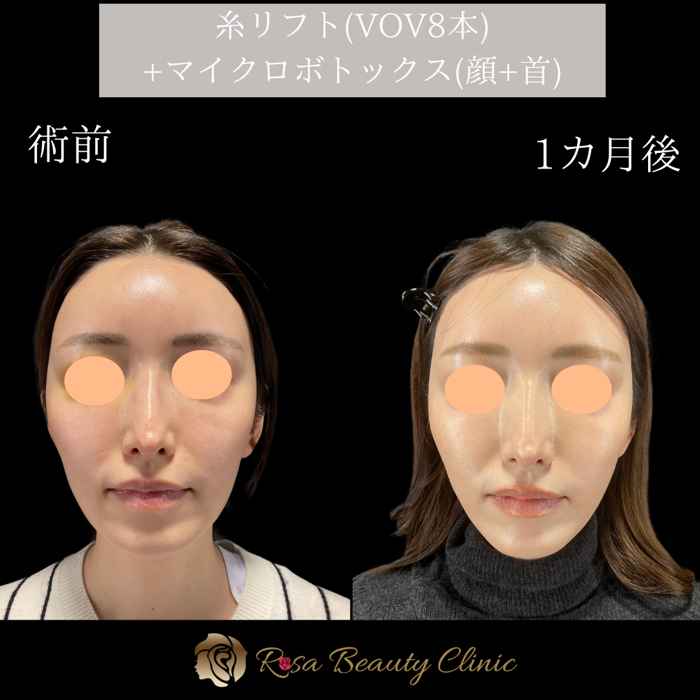 糸リフト(VOV8本)＋マイクロボトックス(顔＋首)の症例写真