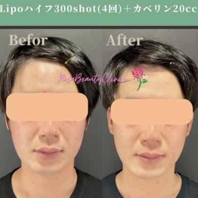 DEEPハイフ（LIPOハイフ）＋脂肪溶解注射の症例写真