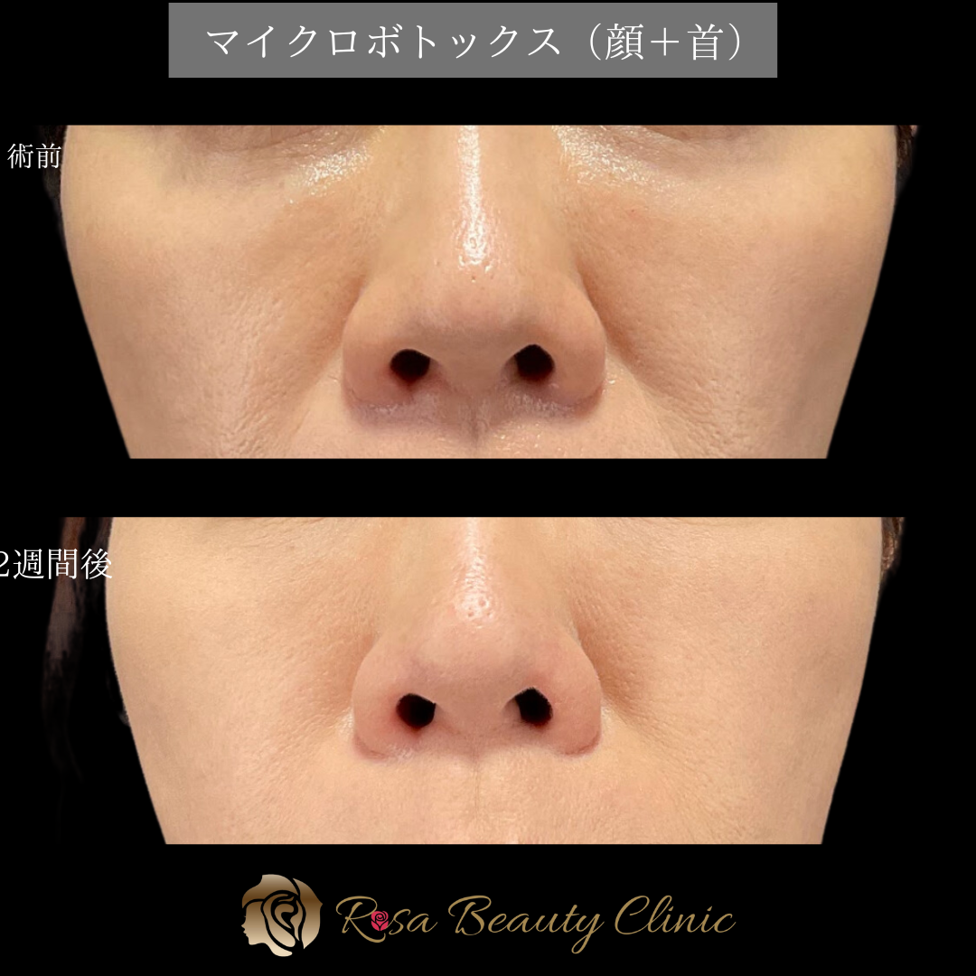 マイクロボトックス（顔＋首） | 名古屋駅近の美容整形ならRosaBeautyClinic（ローザビューティークリニック）名古屋院  美容外科・美容皮膚科・形成外科