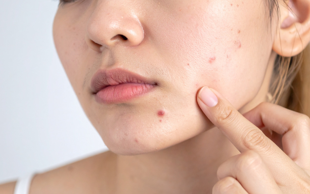 【ニキビ跡】赤み・クレーター・色素沈着を治す！タイプ別おすすめケア徹底解説
